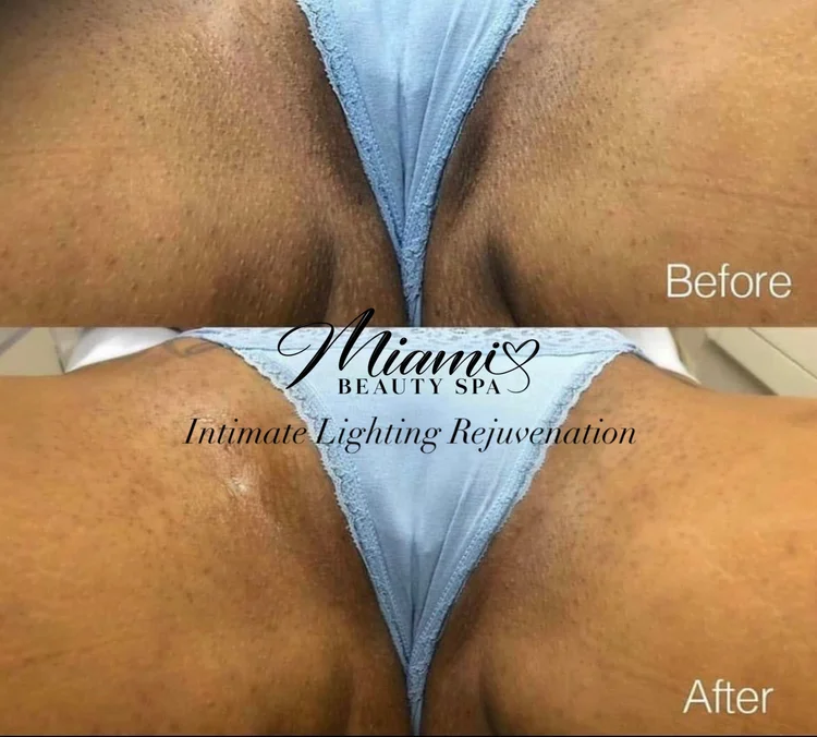 Bikini line before and after intimate bleaching