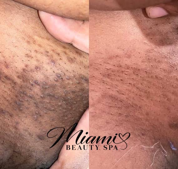 Underarm before and after intimate bleaching