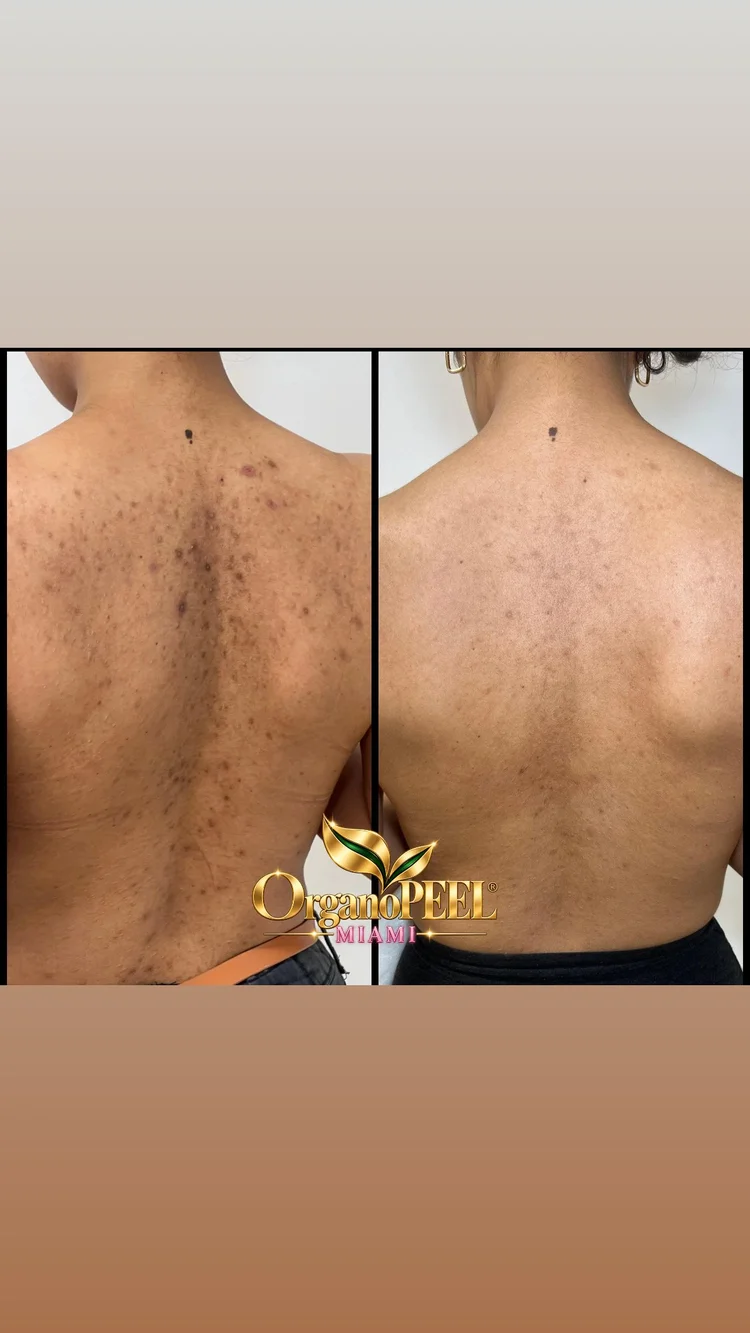 Woman receiving an Organo Peel facial treatment