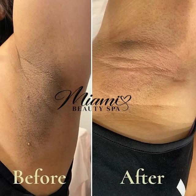 Intimate bleaching treatment