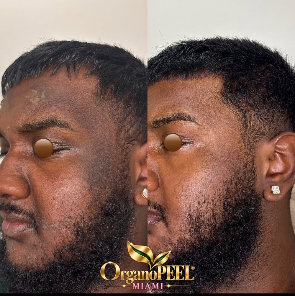 Man's facial skin before and after Organo Peel
