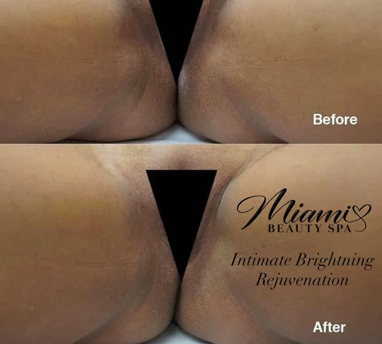 Butt area before and after intimate bleaching