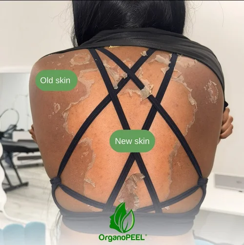 Upper back showing old skin and new skin during Organo Peel