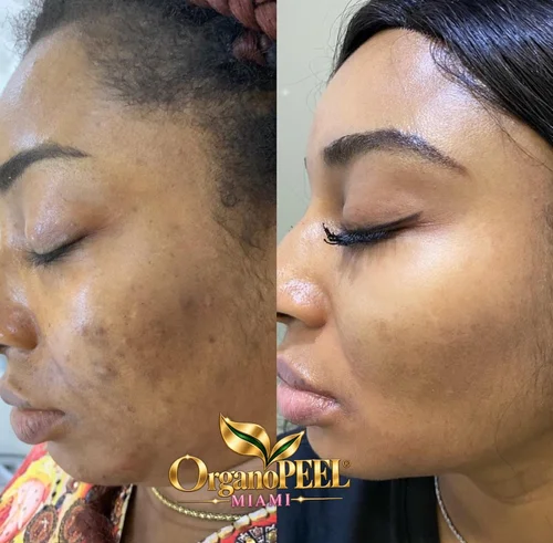 Woman's facial skin before and after Organo Peel