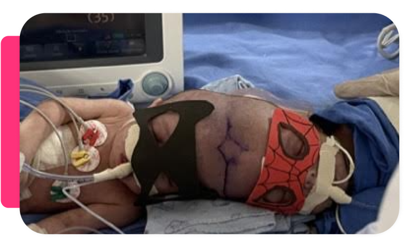 Newborn baby in a hospital incubator wearing a Spider-Man themed face mask, with medical monitoring equipment nearby.