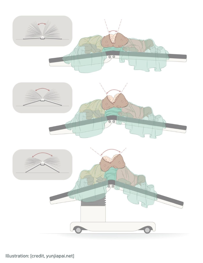 Medical illustration showing the process of adjusting a patient’s head position using a specialized headrest or device, with step-by-step diagrams demonstrating rotation and repositioning for medical imaging or treatment.