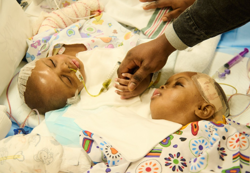 [Twin A] and [Twin B] after their separation, holding hands with their father.