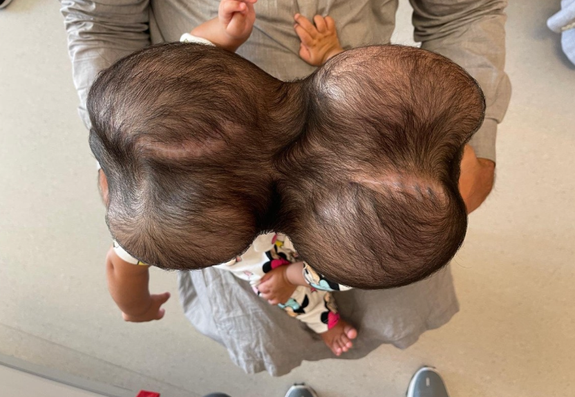 Top view of two young children with a large bald spot on the top of one child's head, sitting on someone's lap.