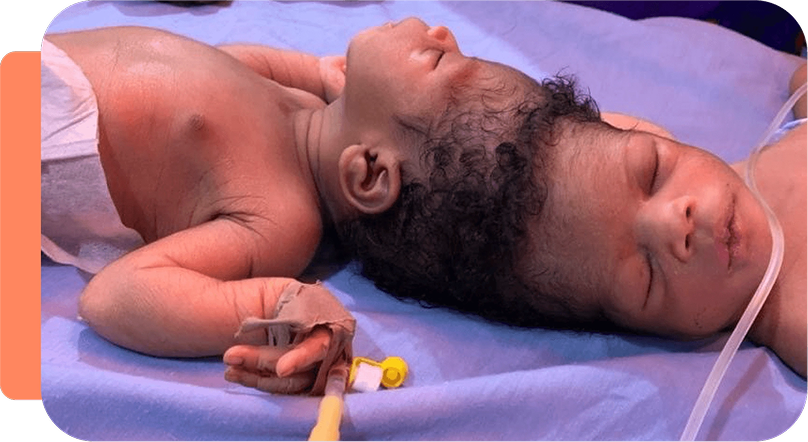 Two premature babies lying side by side in a neonatal intensive care unit, connected to medical tubes and monitors.