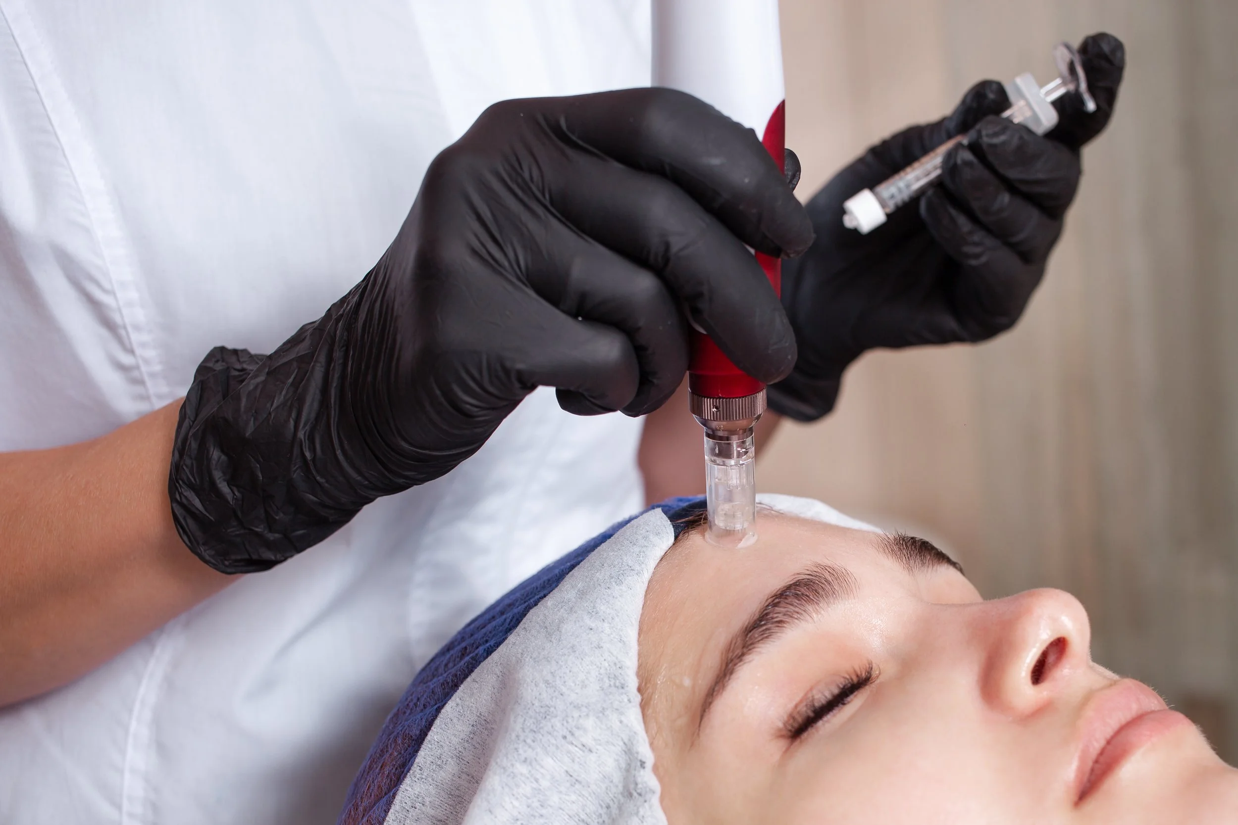 Medspa in Agoura Hills, CA, 91301 | Microneedling with PRP Near Me