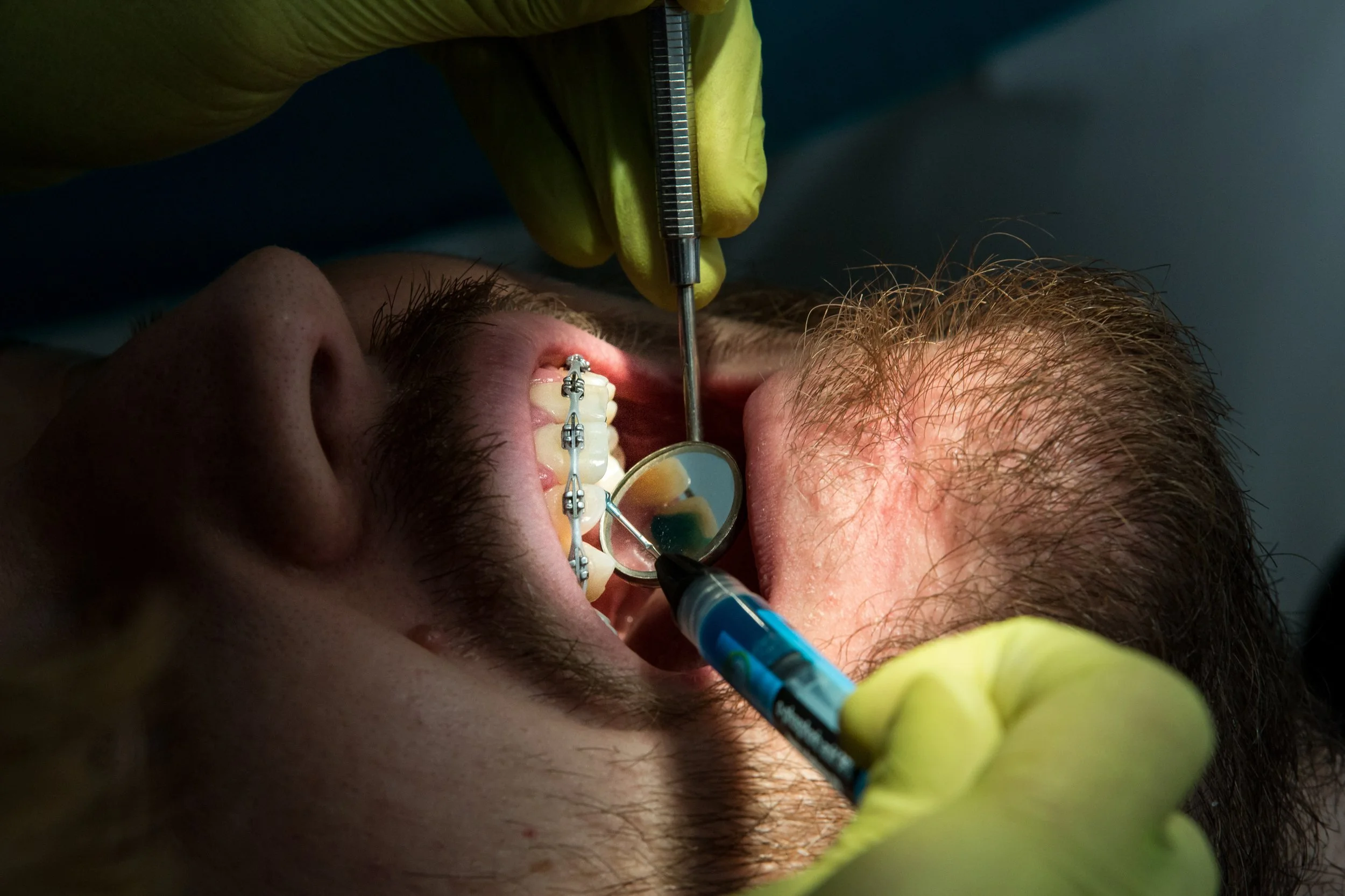 Close-up of a person's mouth with braces during a dental procedure, with a dentist wearing yellow gloves using a dental instrument.