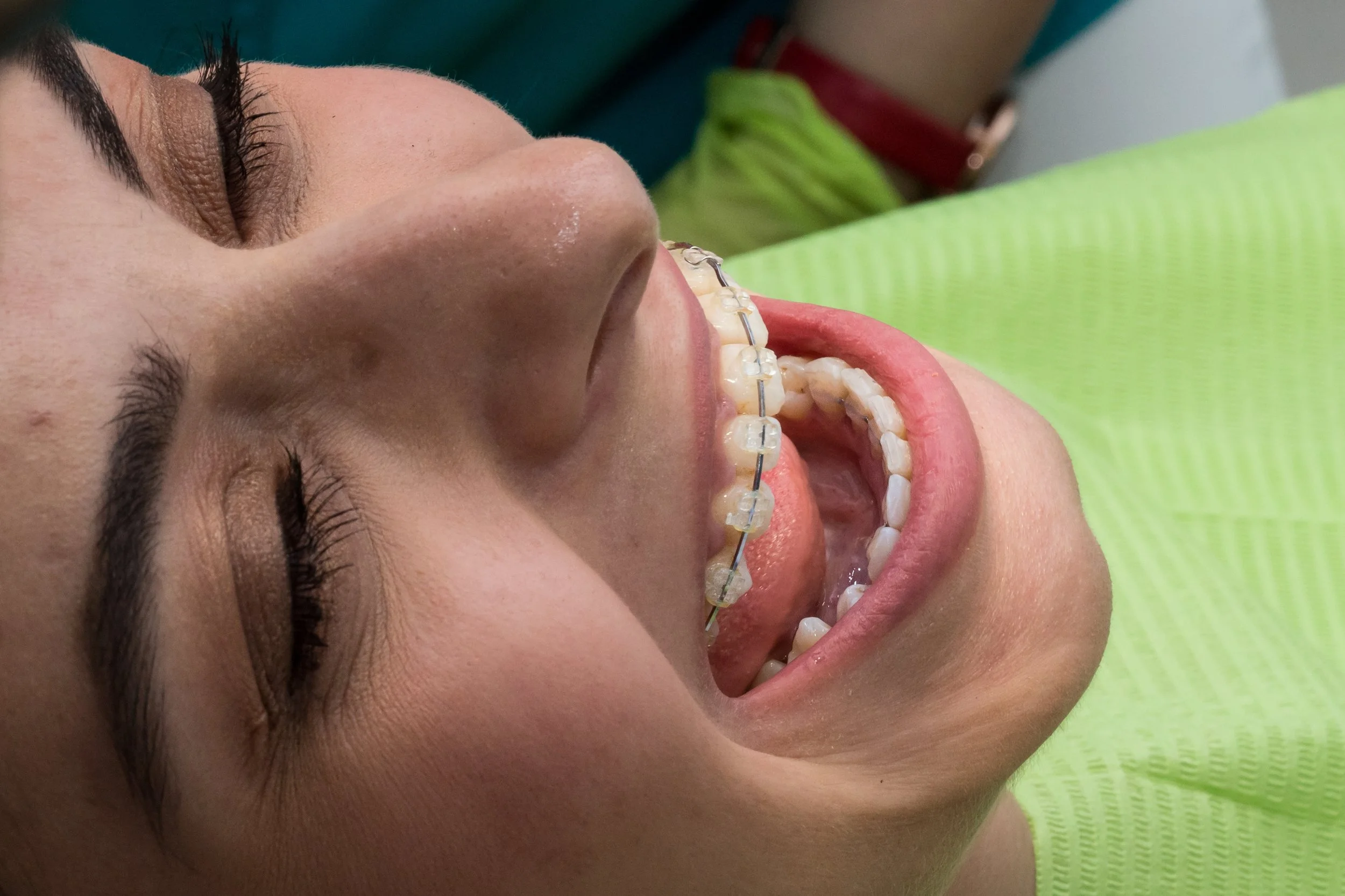 Close-up of a person's face lying down, showing their open mouth with braces on their teeth, and their nose and eyelid visible.