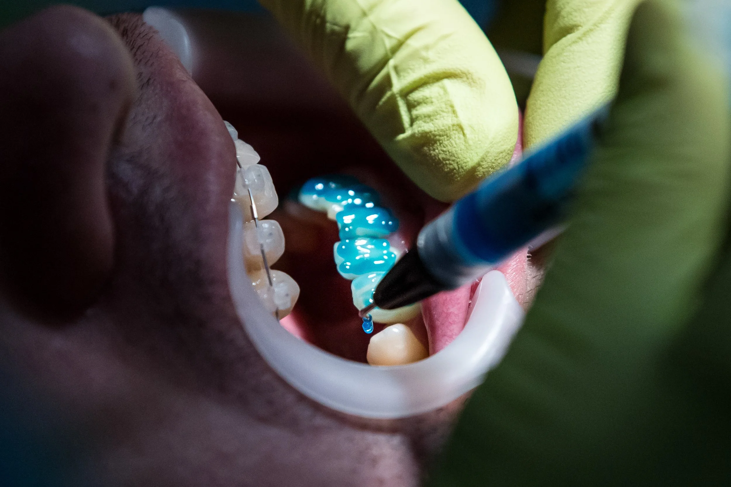 Close-up of a person's open mouth with braces, a dental professional applying blue dental sealant or bonding material to teeth using a syringe, with gloves visible.