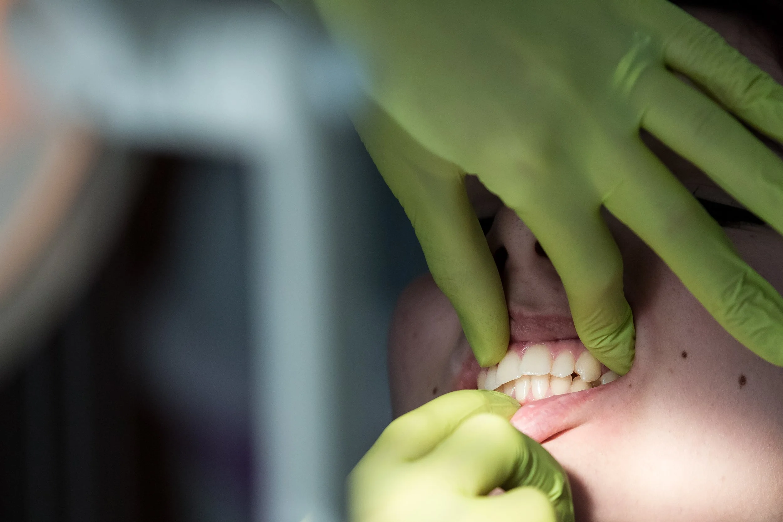 Close-up of a dental procedure with a person wearing a green glove holding their mouth open, revealing teeth and gums.