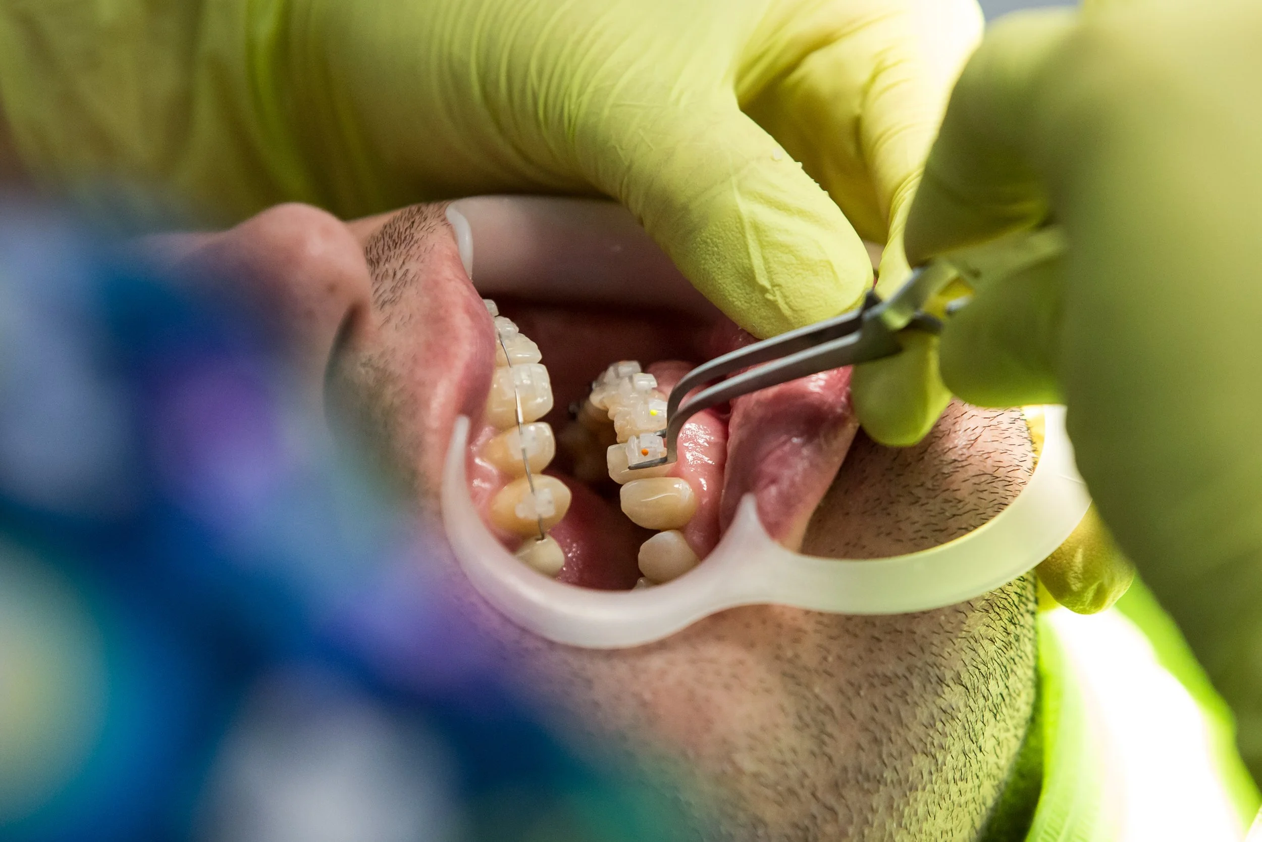 Close-up view of a person's open mouth with braces on their teeth, held open by a dental tool, with yellow gloves in the background.