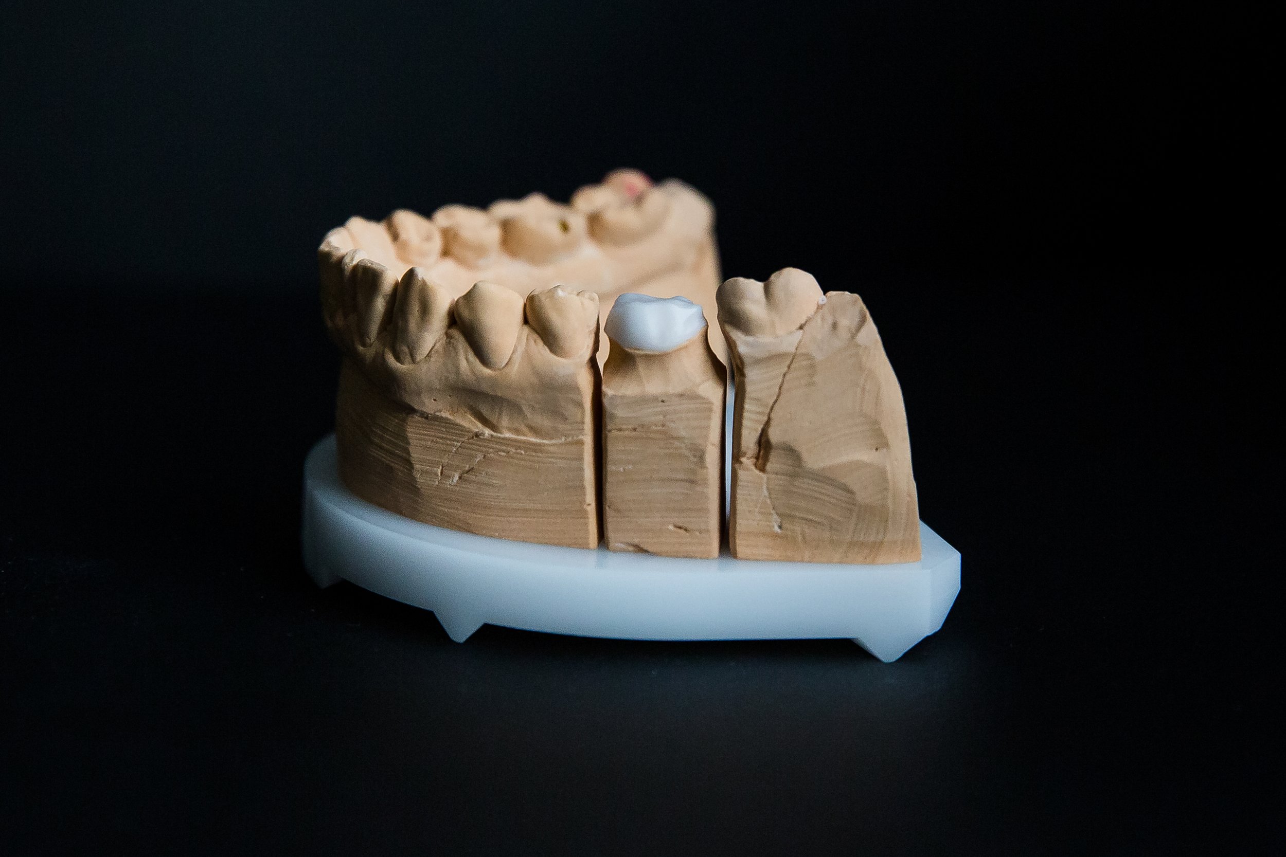A dental model of teeth, focusing on the molars, with one tooth covered by a white dental crown. The model is set against a black background.