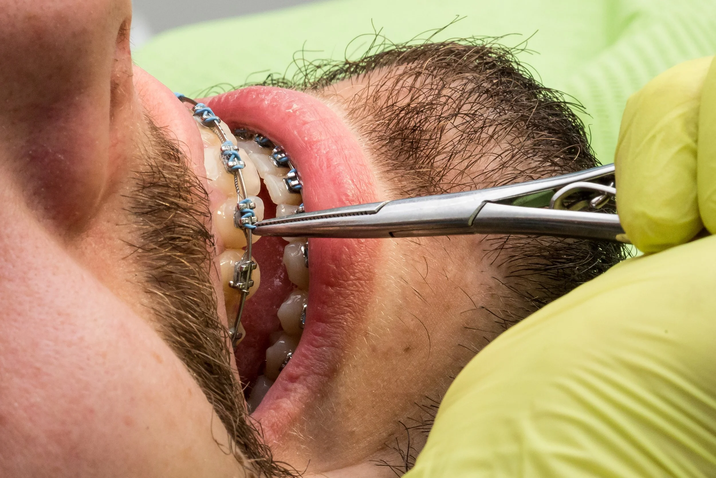 Close-up of a person with braces cleaning their teeth with a dental tool, wearing yellow gloves, with wet hair and a green background.