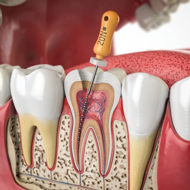 A dental model showing a tooth with a root canal procedure, including a dental drill inserted into the tooth's pulp chamber.
