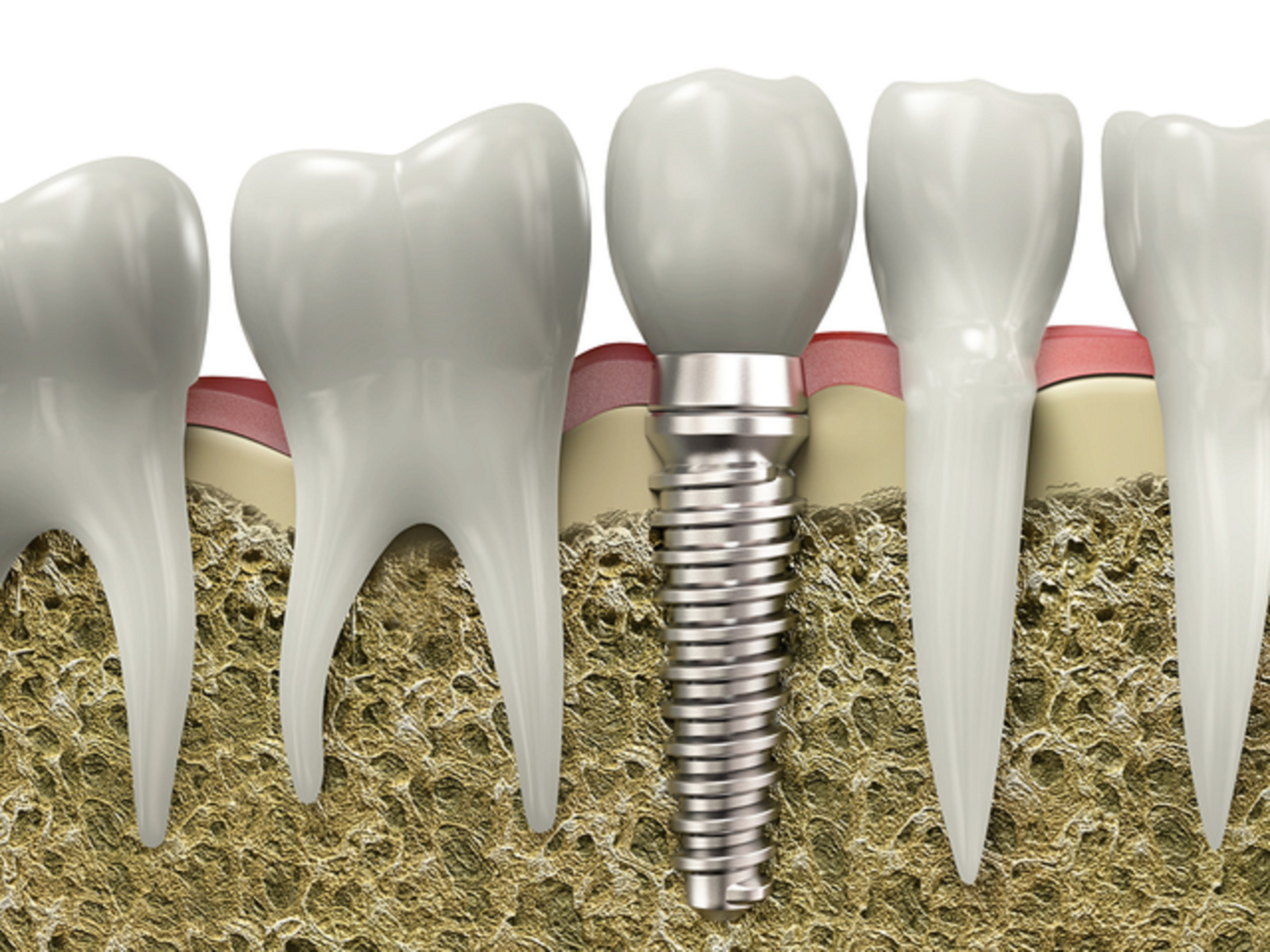 A close-up illustration of a dental implant embedded in the jawbone, with a titanium screw, surrounded by teeth and gums.