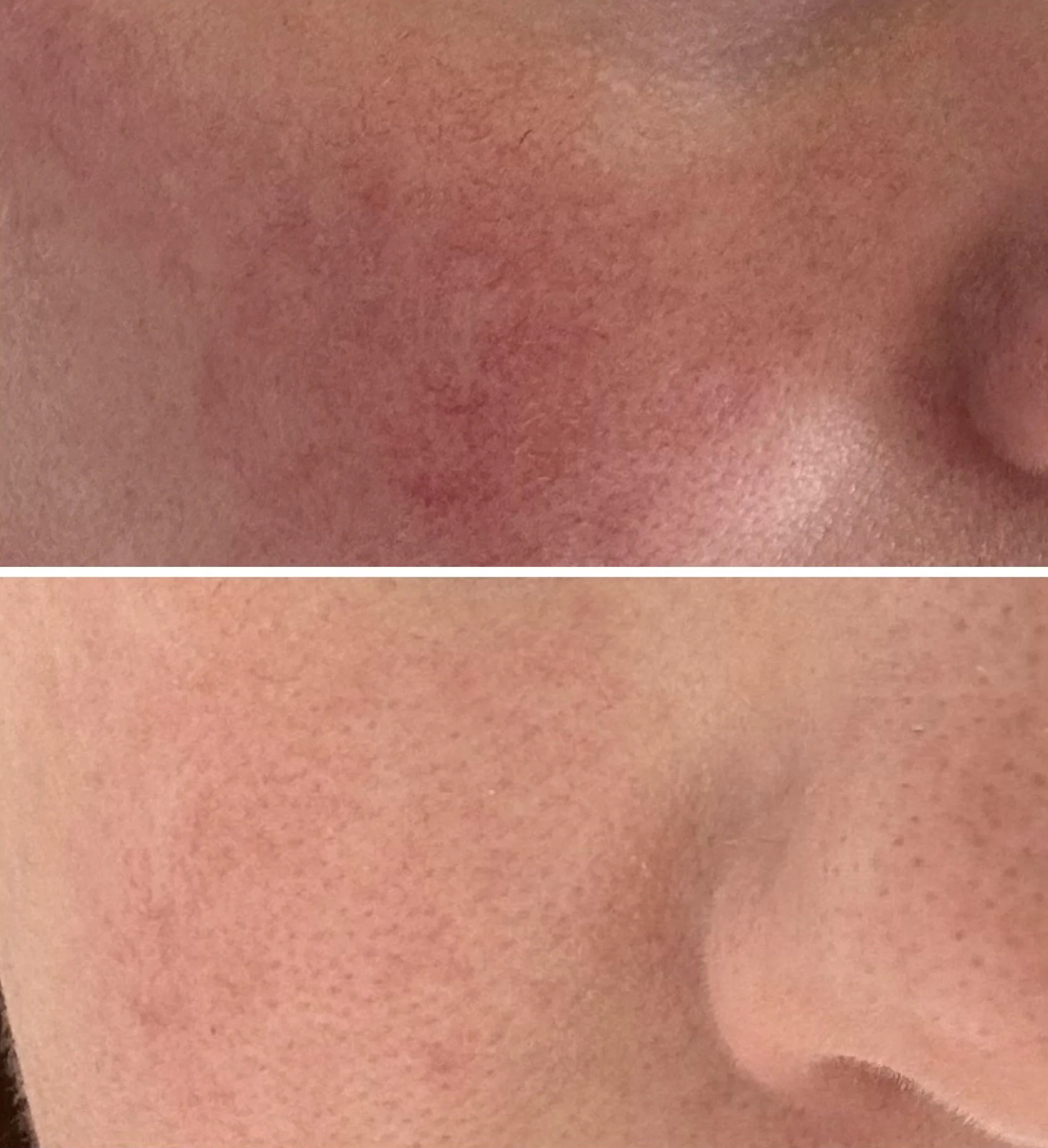Side-by-side comparison of a woman's face before and after skincare treatment, highlighting improvements in skin texture and tone.