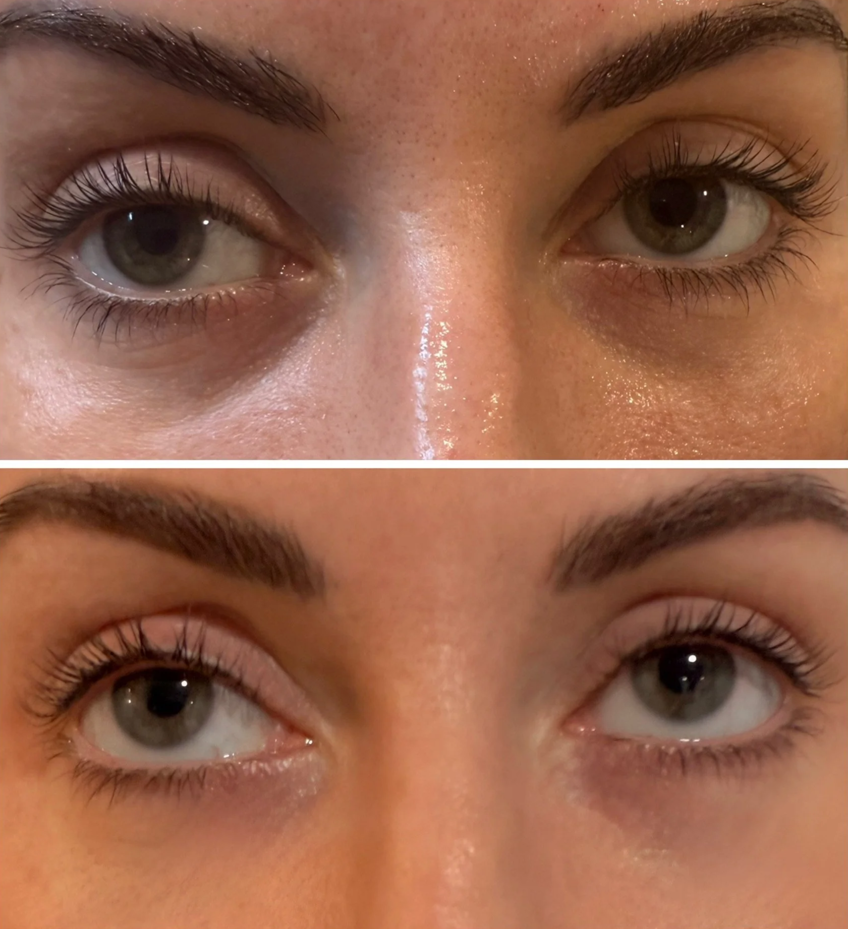 Comparison of a woman's eyes before and after medical aesthetics treatment.