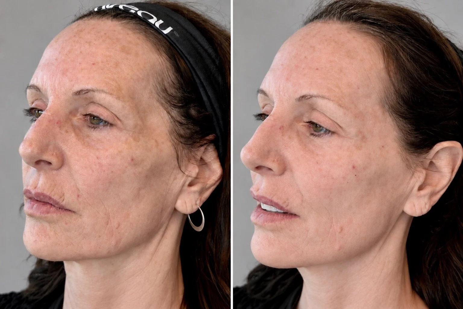 Side-by-side comparison of a woman's face before and after skincare treatment, highlighting improvements in skin texture and tone.