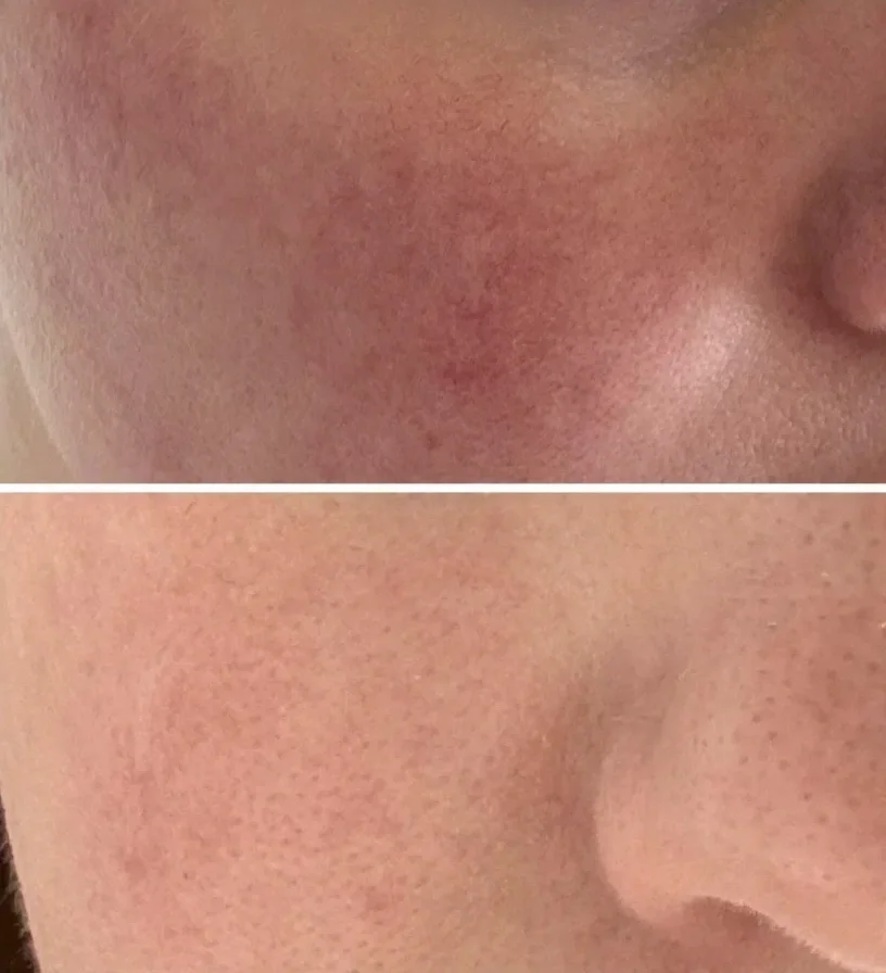 Side-by-side comparison of a woman's face before and after skincare treatment, highlighting improvements in skin texture and tone.