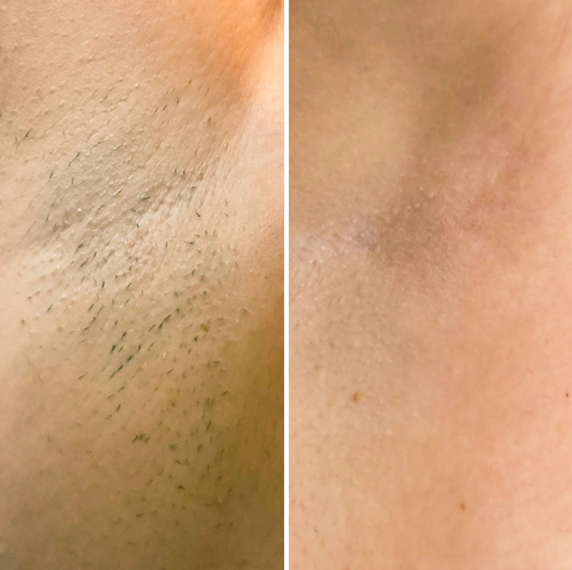 Side-by-side comparison of a woman's skin texture before and after laser hair removal.