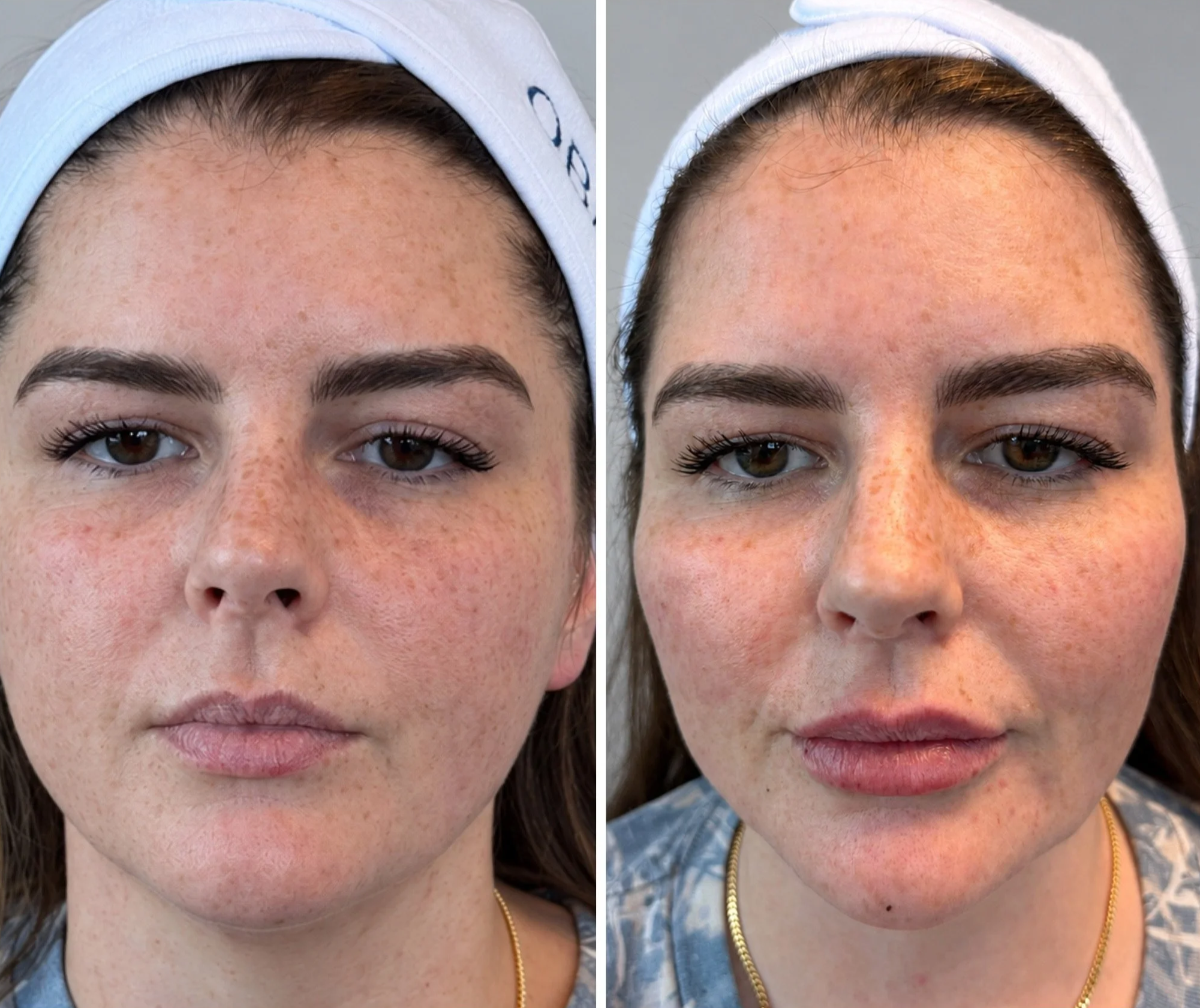 Comparison of a woman before and after medical aesthetics treatment.