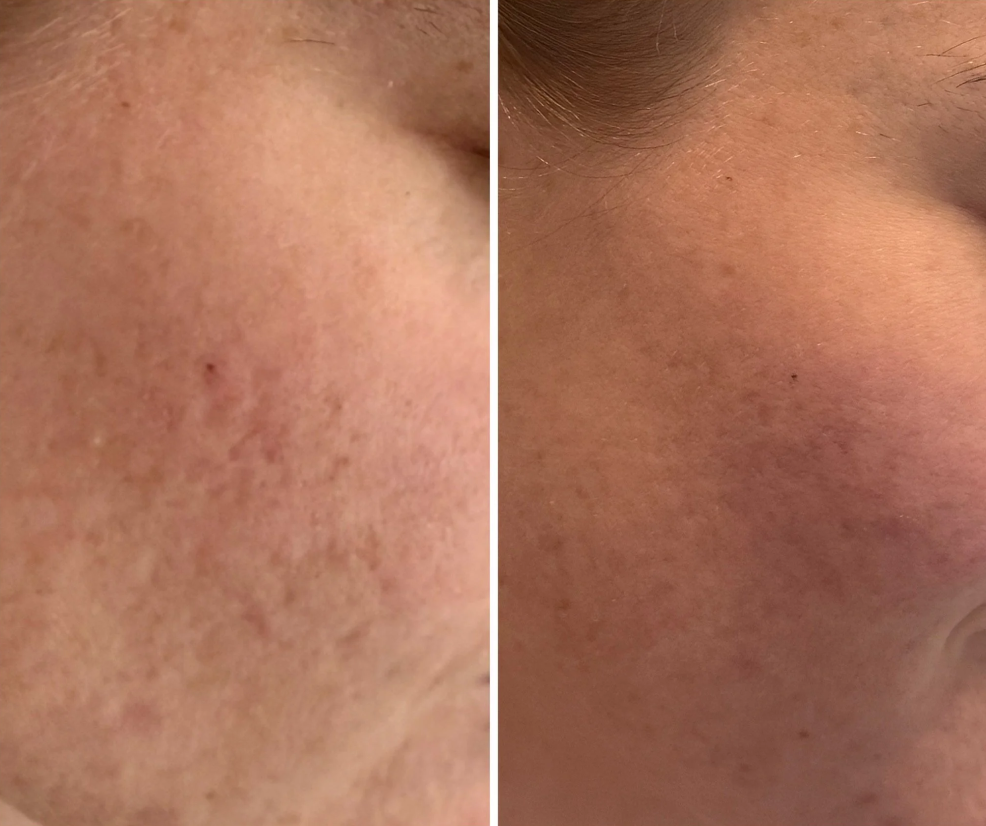 Side-by-side comparison of a woman's face before and after skincare treatment, highlighting improvements in skin texture and tone.