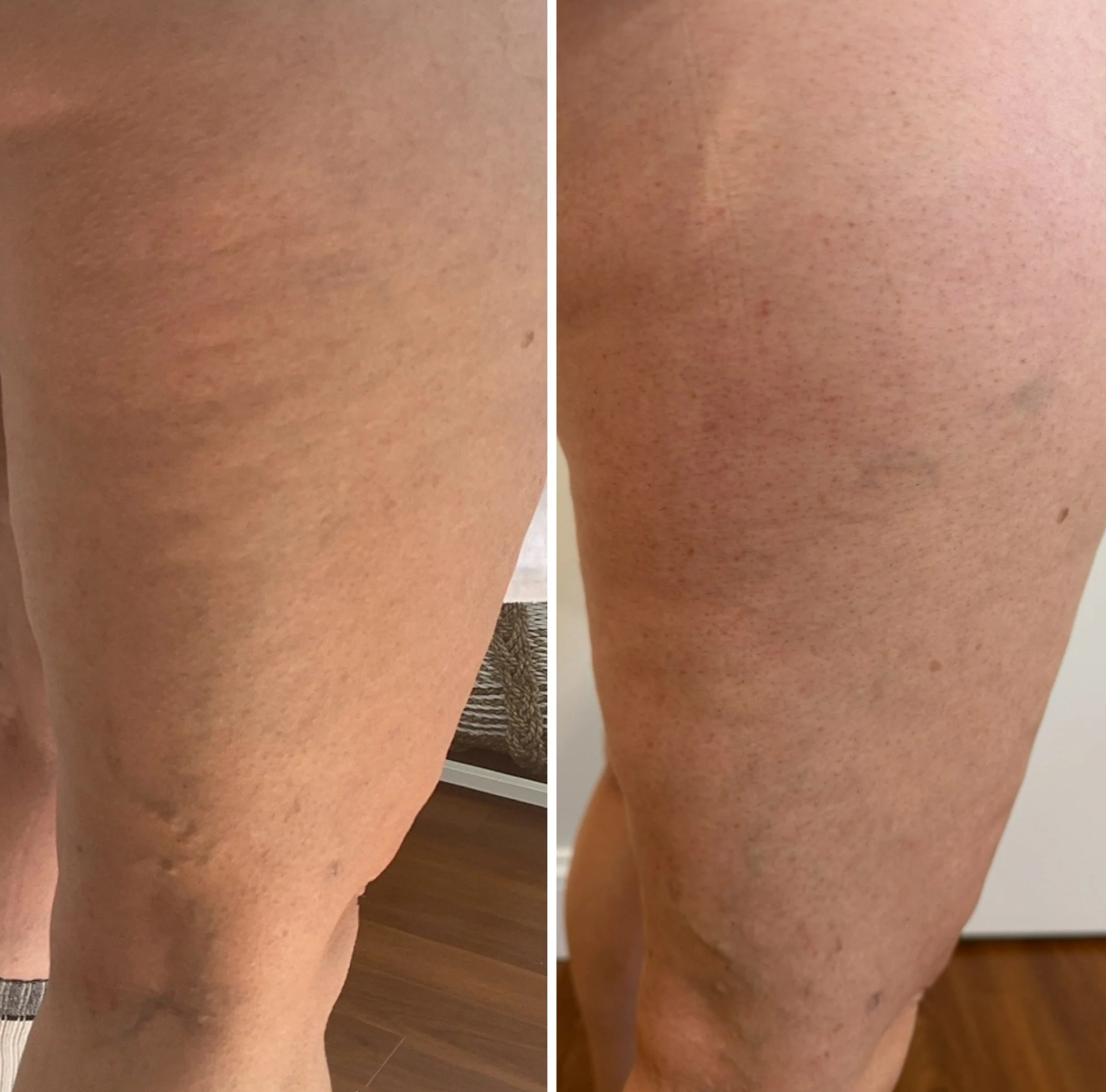 Comparison of a a woman's legs before and after skin smoothening, body contouring treatment.