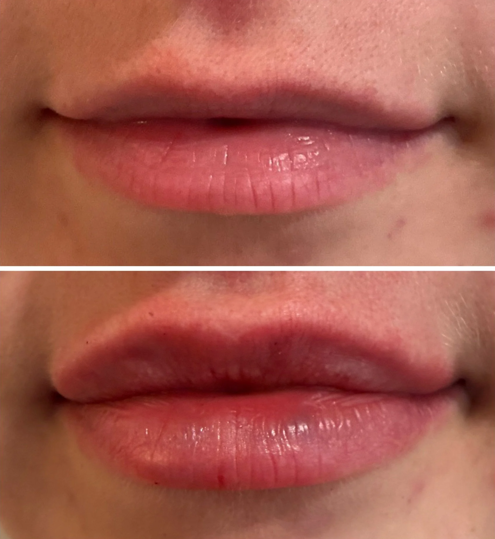 Comparison if a woman's lips before and after filler treatment.