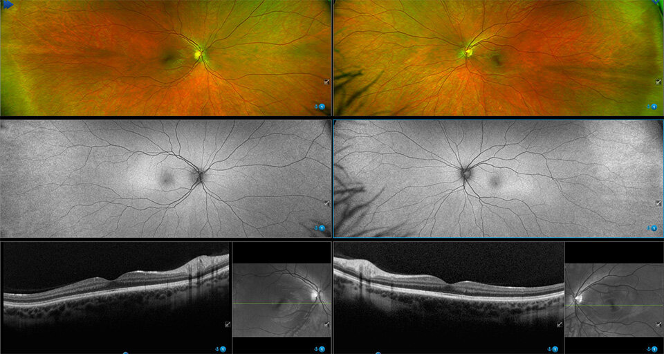 Optos Monaco Digital retinal imaging