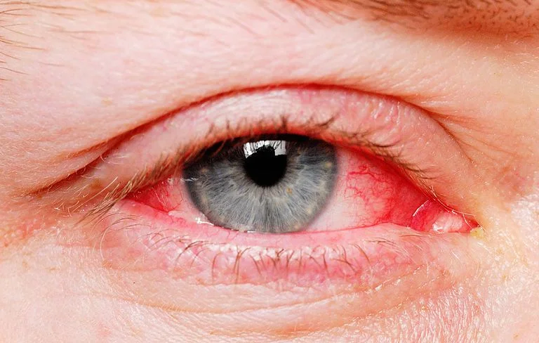Allergy Eyes
