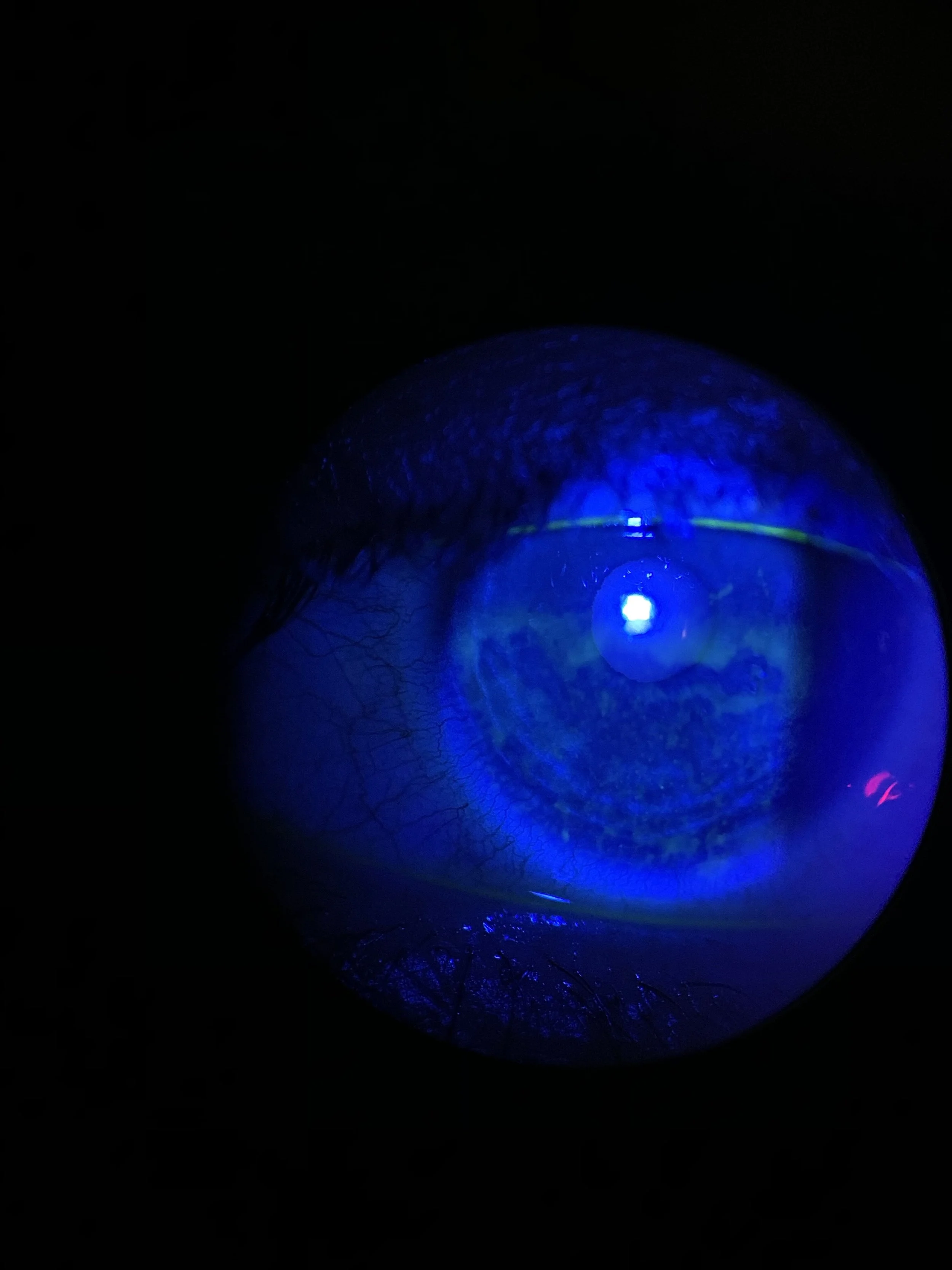 The Hubble Contact Lens Conundrum