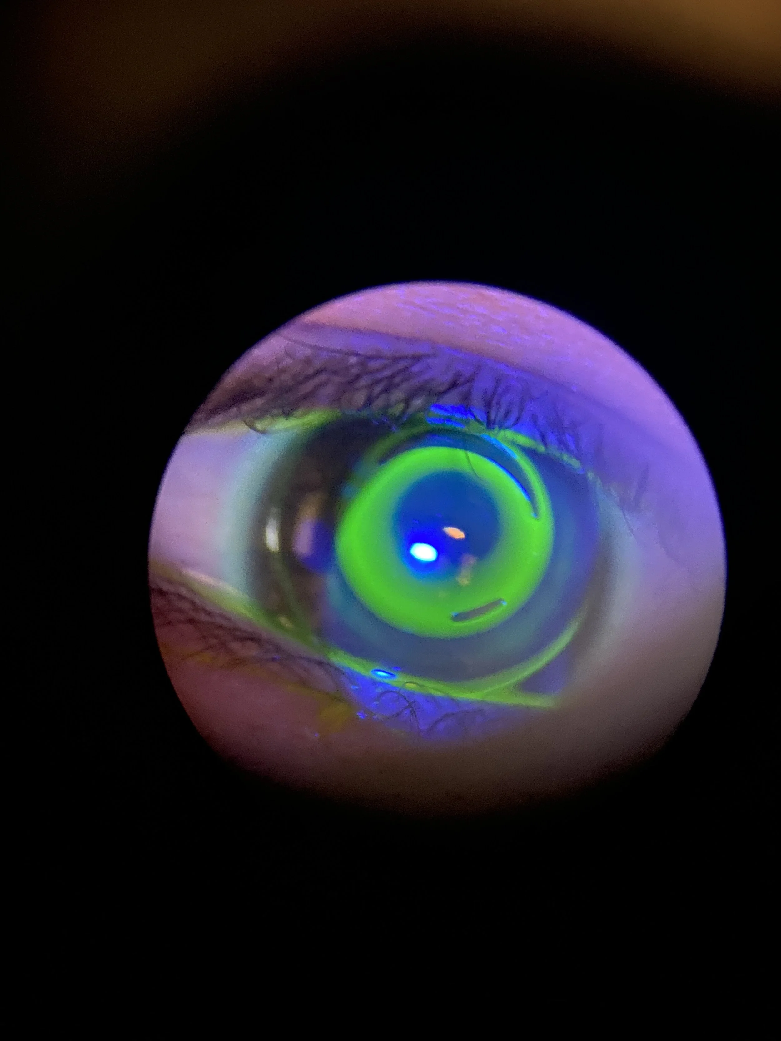 OrthoKeratology Retainer