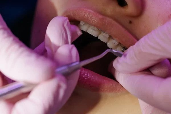 A dental professional administering a dental procedure on a patient's teeth, with focus on the patient's mouth and hands wearing pink gloves.
