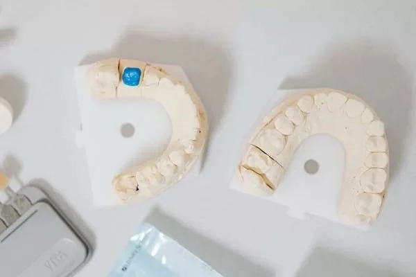 Dental molds of upper and lower teeth, a blue dental marker, and a dental tool on a white surface.