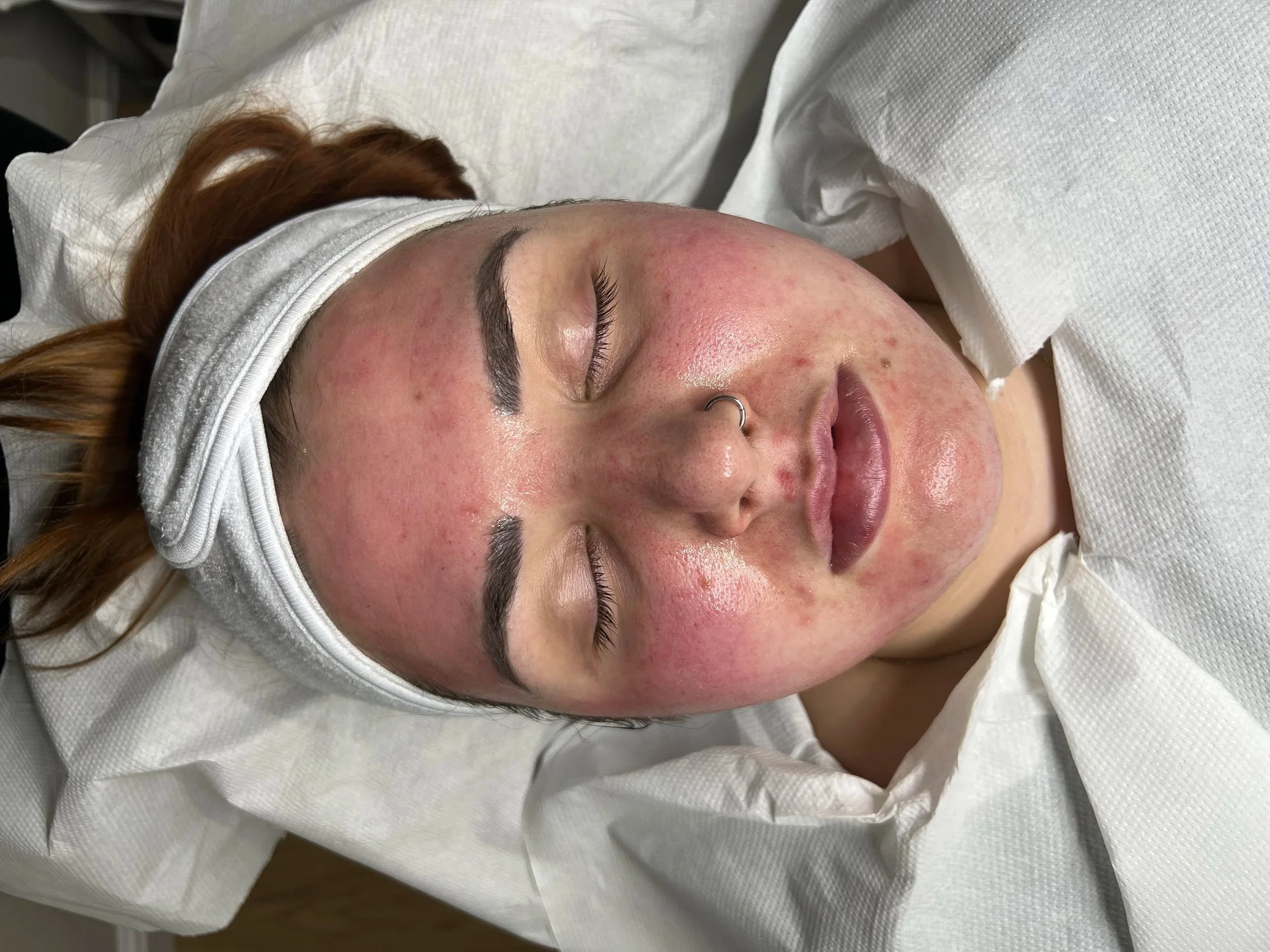 How Deep Does Microneedling Really Need to Go?