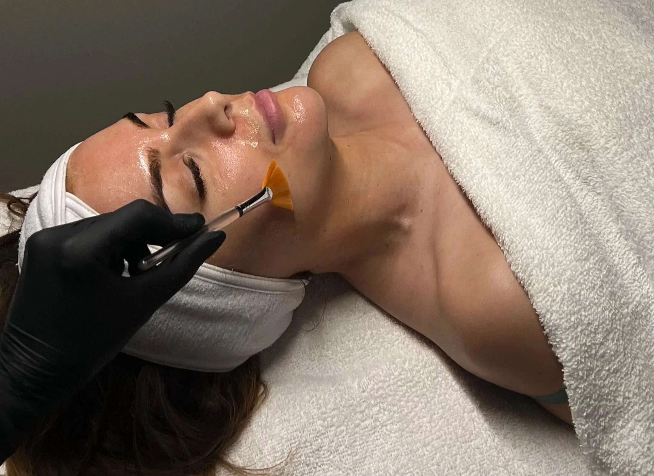Professional chemical skin peel treatment at Beau.t skin clinic in Horsham.