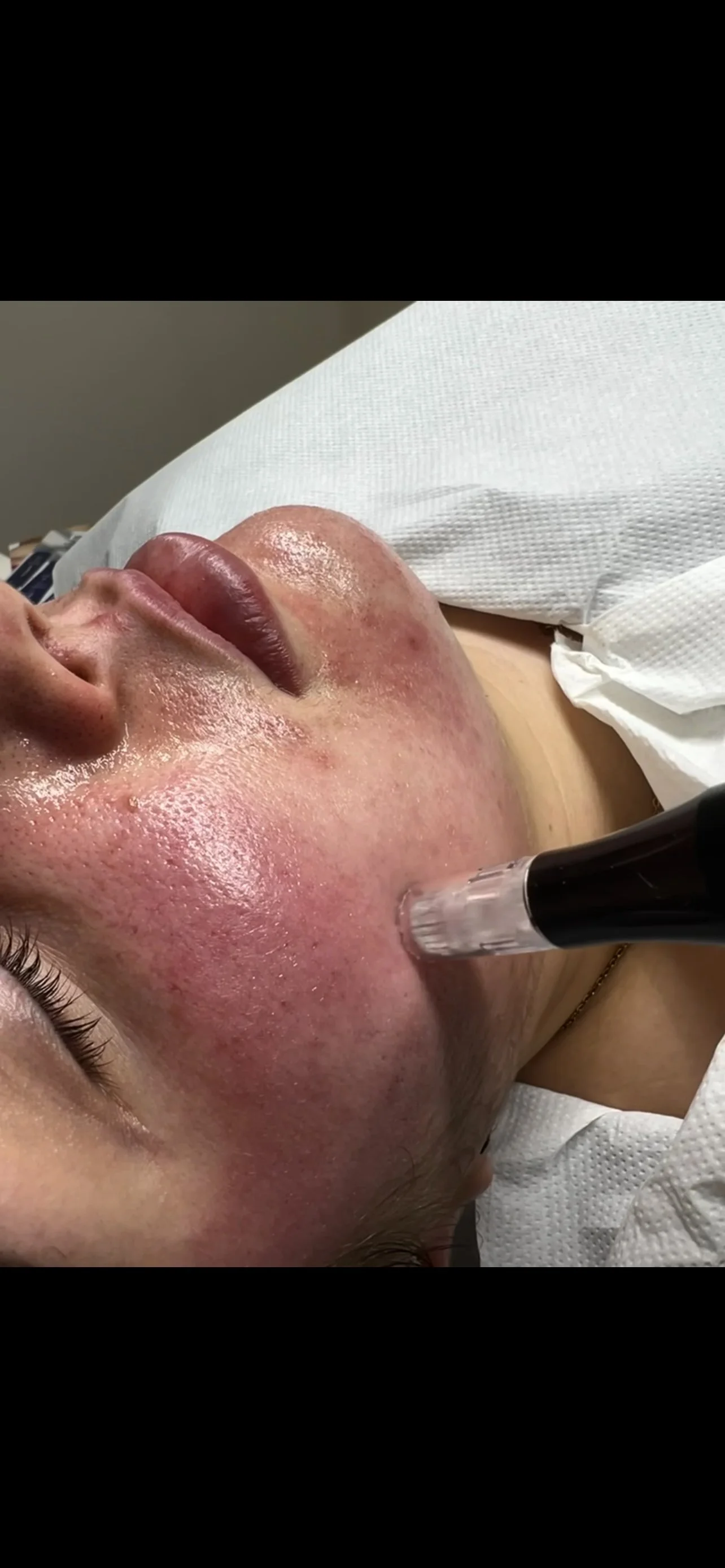 Close-up of a professional skin treatment being performed at Beau.t.