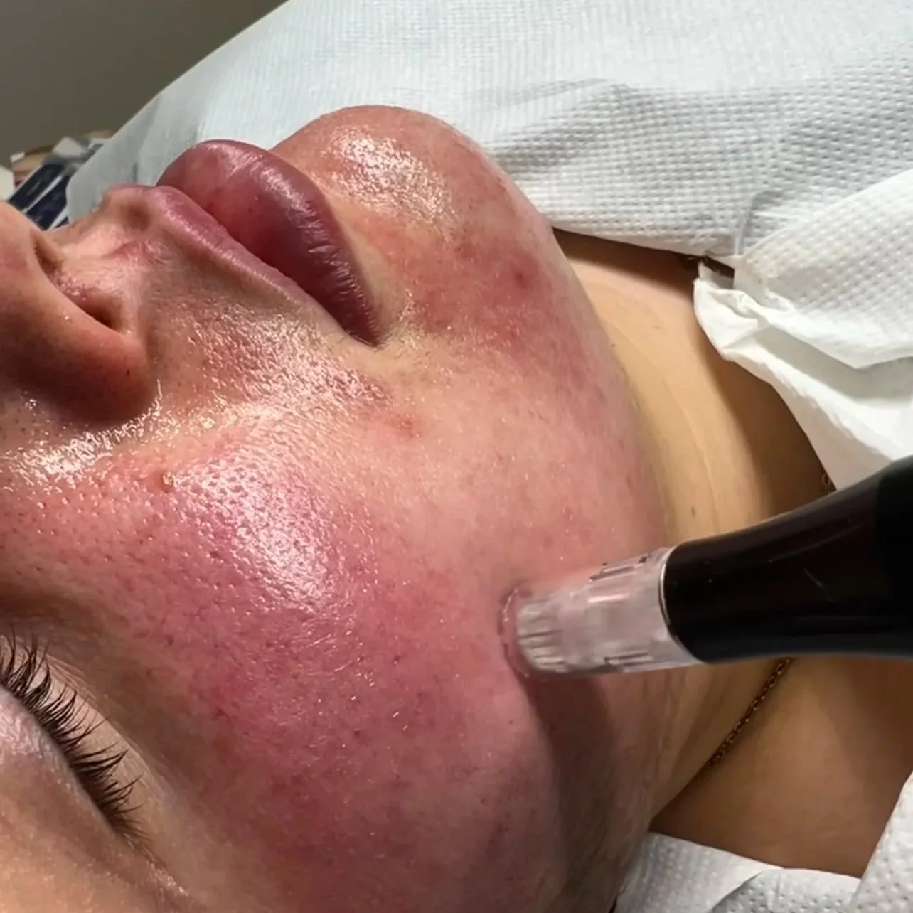 Close-up of a professional facial treatment being performed at Beau.t.