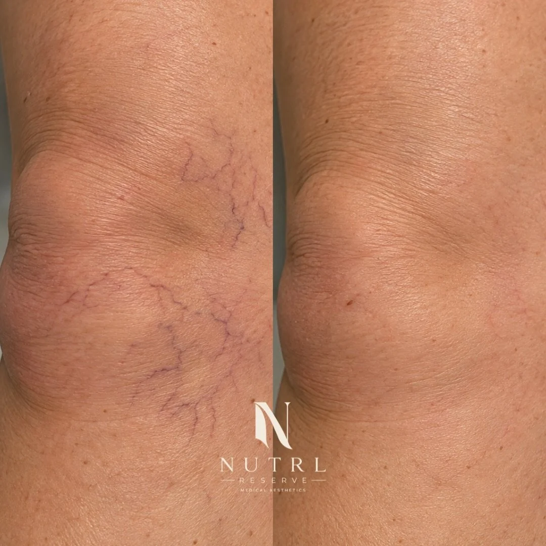 Spider veins? We can treat those too. ✨

The Splendor X uses targeted laser energy to heat unwanted superficial blood vessels, causing them to gradually collapse and be naturally reabsorbed by the body. Over the following weeks, treated veins can bec
