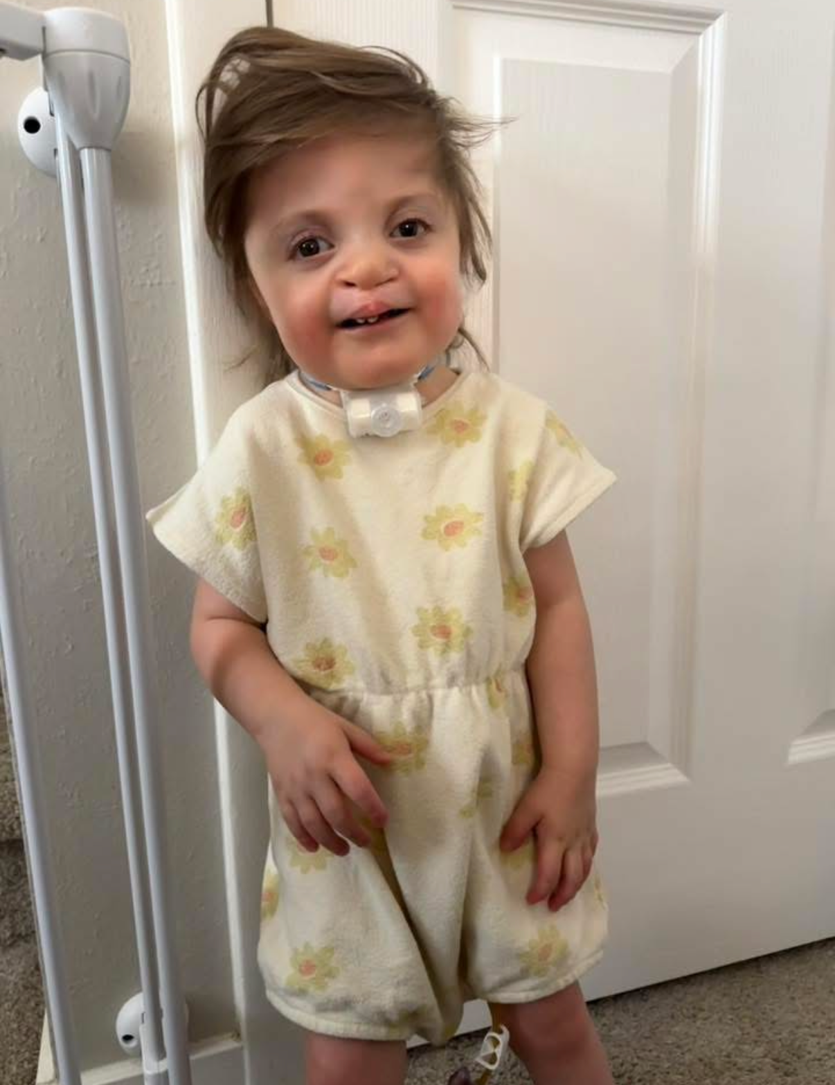 A young girl with short, messy hair standing indoors near a white door, wearing a yellow floral dress and a medical tube around her neck, with a slight smile and her hands resting on her dress.