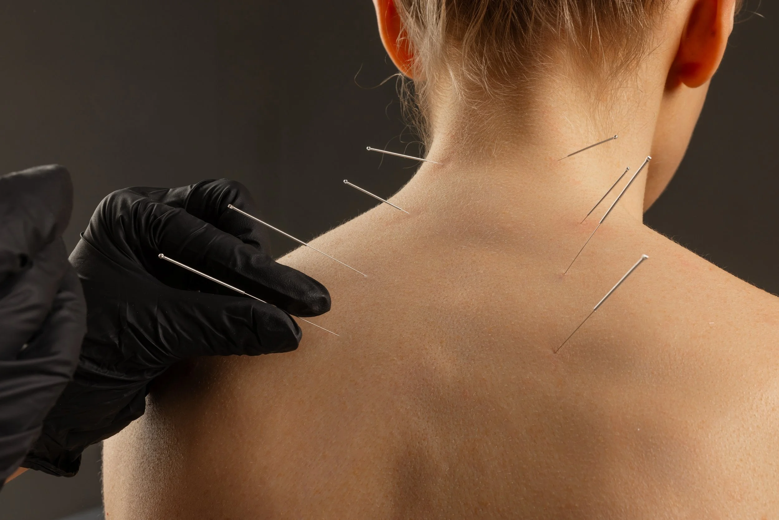 Close-up of a person receiving dry needle treatment on the neck and shoulder area with multiple dry needles inserted to relieve tension