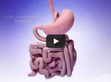 Mini Gastric Bypass Surgery
