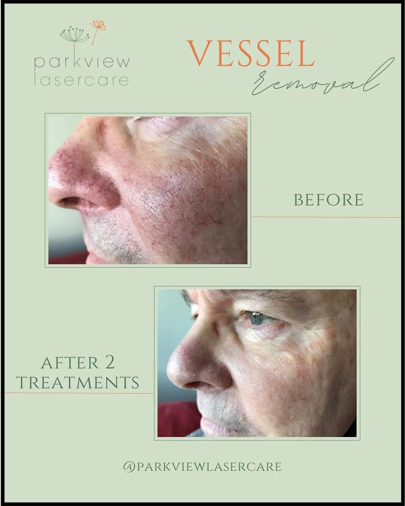 Before and after images of a man's face showing successful treatment of red vessels at Parkview Lasercare.