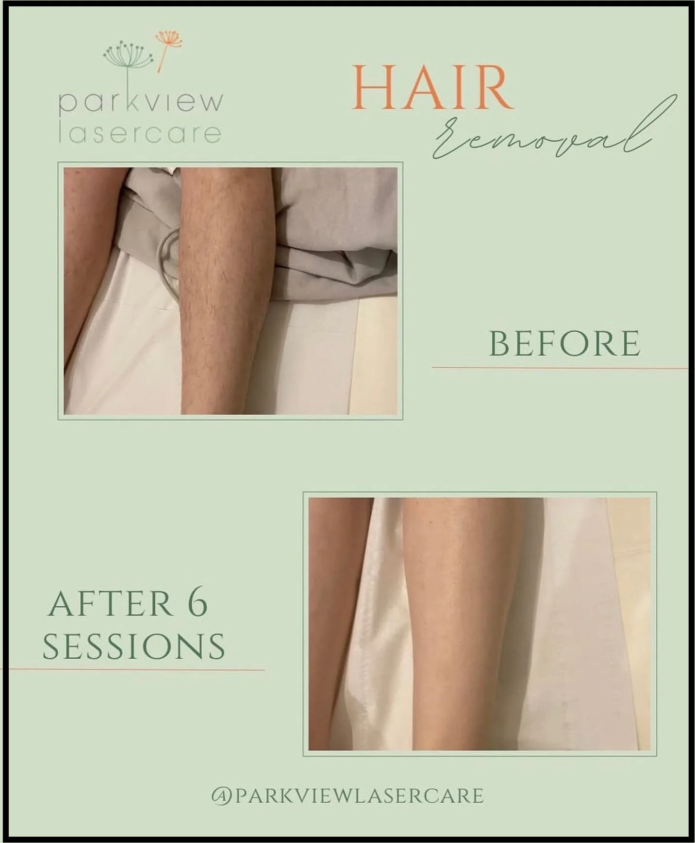 Side-by-side comparison of a person's leg before and after six laser hair removal sessions at Parkview Lasercare, showing reduced hair growth.