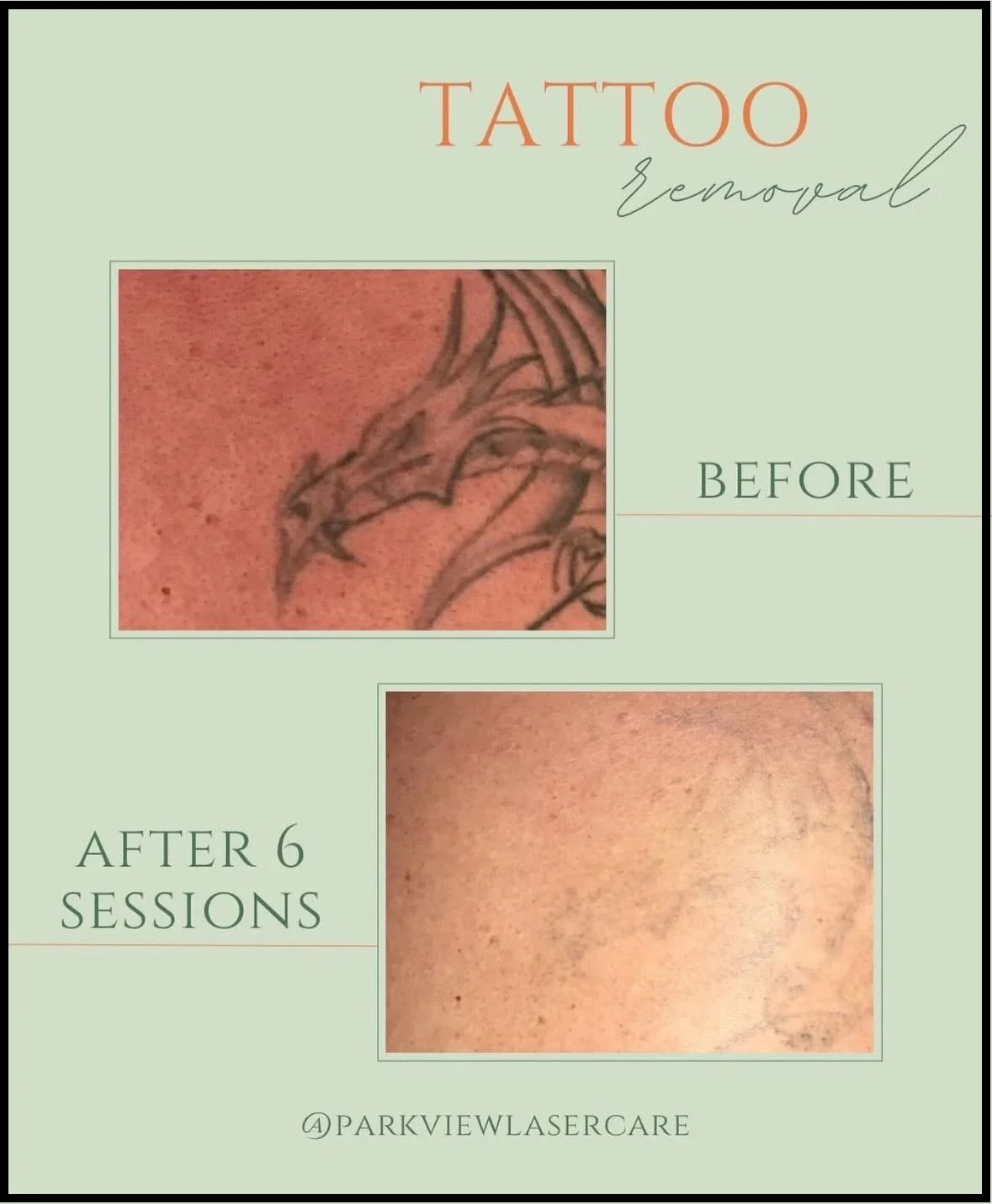 Before and after images showing tattoo removal of a dragon tattoo, with the tattoo significantly faded after six sessions at Parkview Lasercare.
