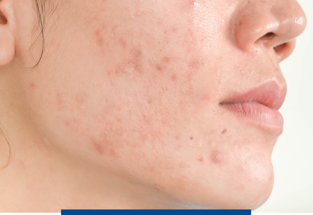 young woman with facial acne outbreak